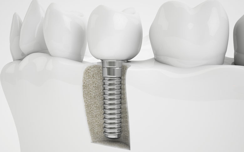 dental implant model Cape Coral FL