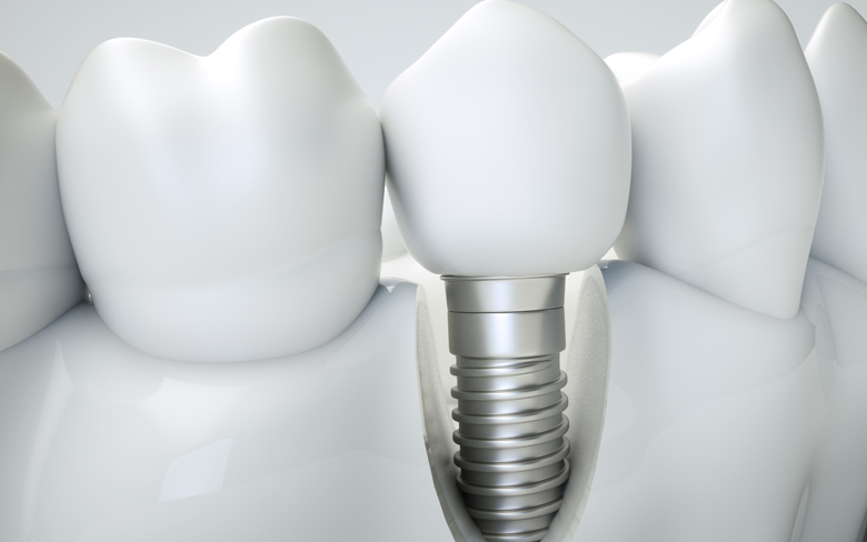 dental implants model Cape Coral FL