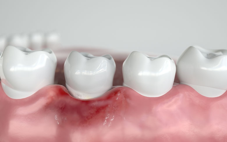 failing dental implant Cape Coral FL