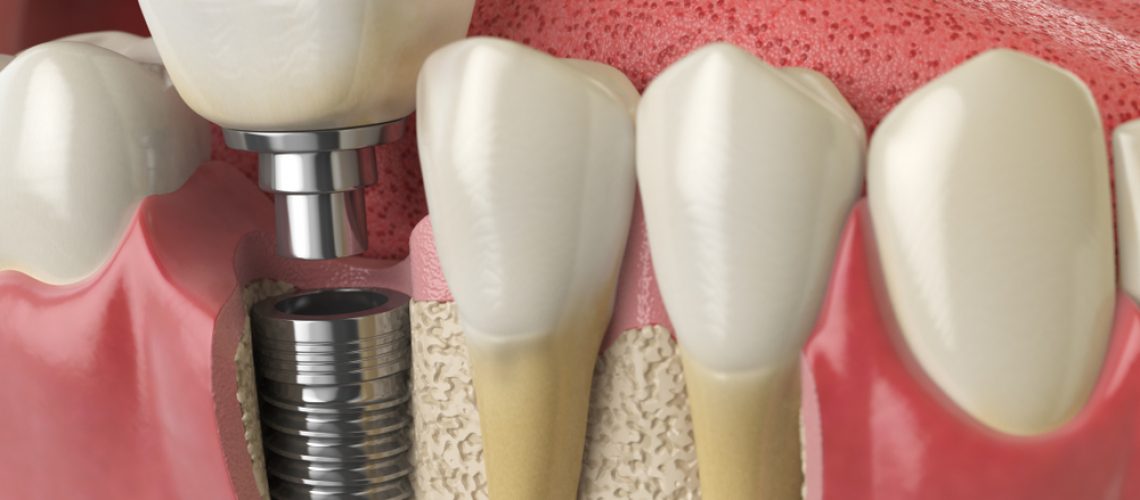 Why Choose Dental Implants